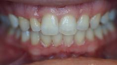 picture of teeth before bonding