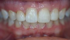 Picture of Teeth after Bonding